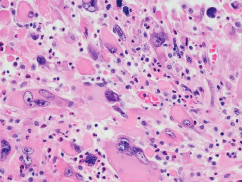 Lung cancer screening: cutting costs, saving lives - article image