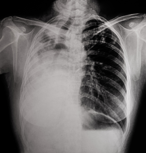 ERS welcomes the positive results of NELSON trial - article image