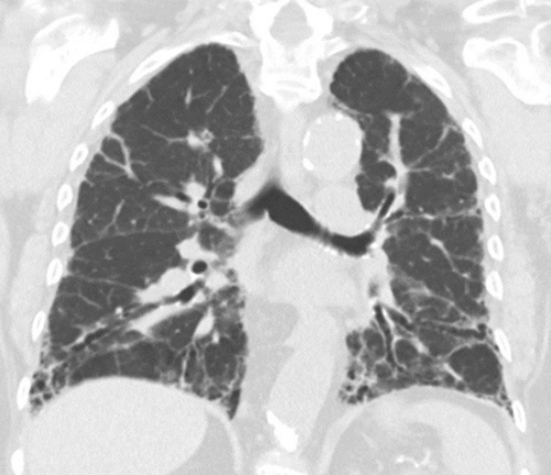 Interstitial lung diseases at the ERS Congress - article image