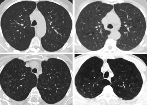 Emphysema is an independent risk factor for non-pulmonary and lung cancer - article image