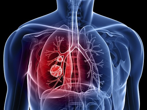 Blood testing at time of lung cancer diagnosis facilitates more rapid treatment - article image