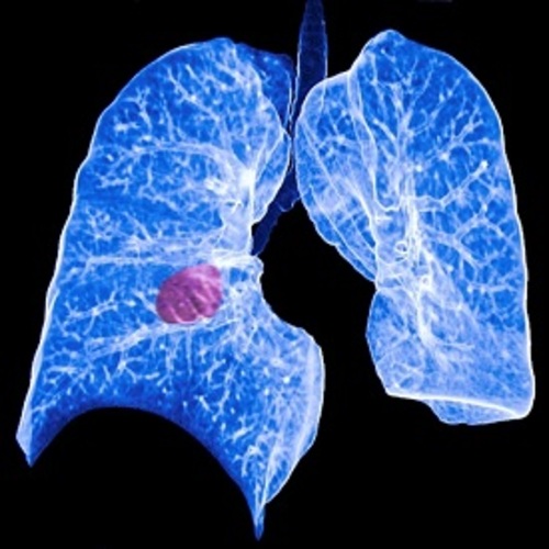 ERS joins Forum of International Respiratory Societies to observe World Lung Cancer Day 2016 - article image