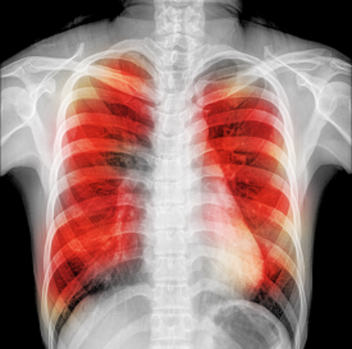 Study finds new mechanism of tuberculosis infection - article image