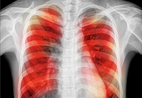 Healthcare workers in low and middle-income countries show high prevalence of latent TB infection - preview image