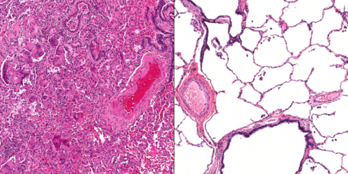 E-cigarette user found to have rare form of lung scarring typically found in metal workers - article image
