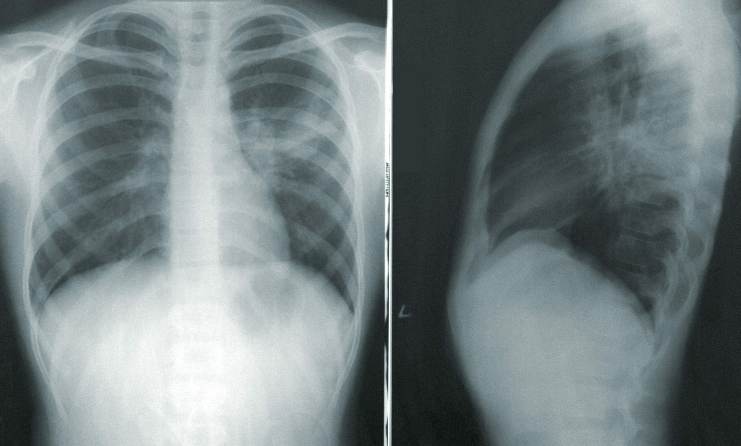 Outcome of Hospitalisation for COVID-19 in Patients with Interstitial Lung Disease: An International Multicenter Study - preview image