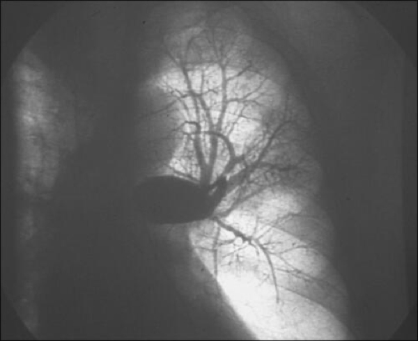 ERS Statement on Chronic Thromboembolic Pulmonary Hypertension - article image