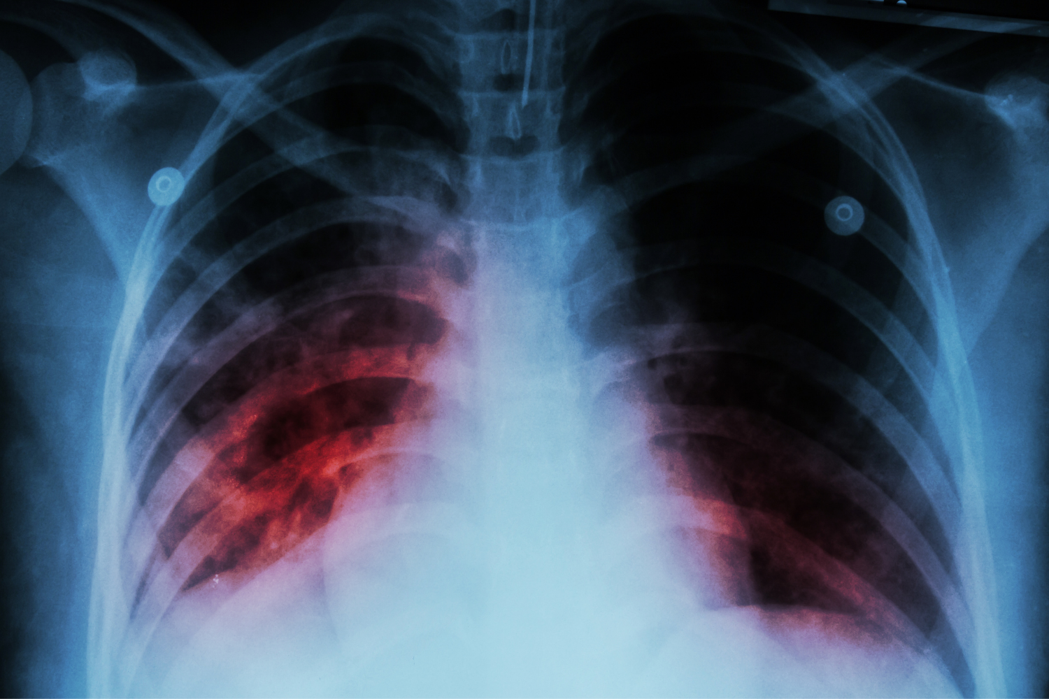 Global respiratory groups join WHO, calling on world leaders to act on the commitments made to end TB - article image