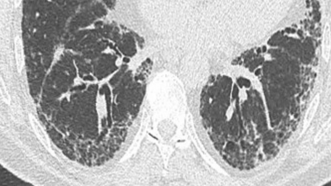 Debate – Controversies in interstitial lung disease - preview image