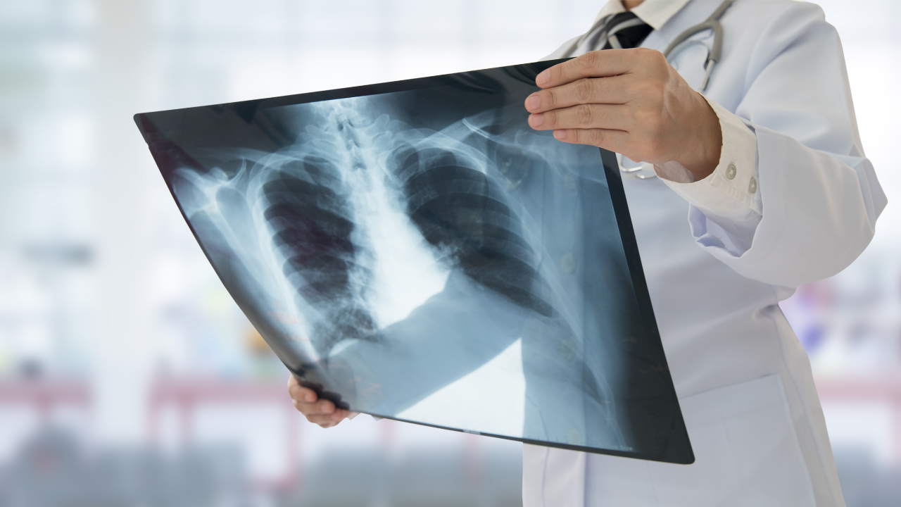 Forum of International Respiratory Societies calls for collaborative efforts to fight pneumonia – focusing on those at greatest risk - article image