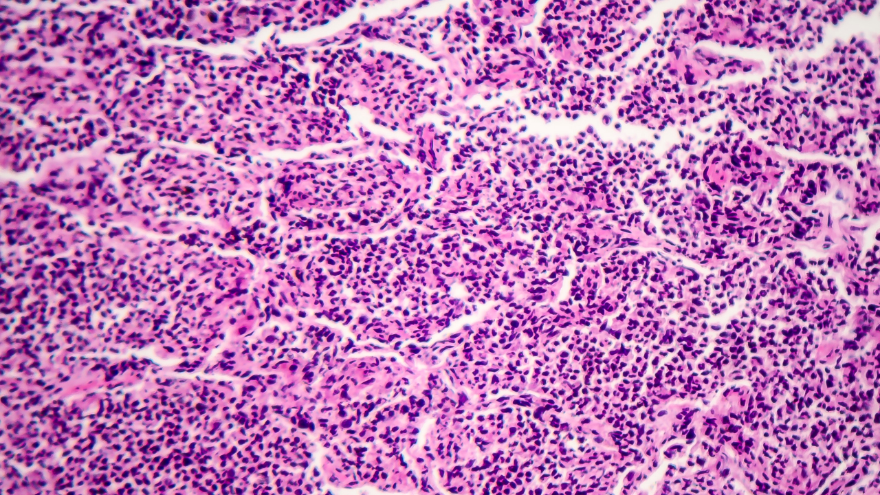 Cryobiopsy versus genomic classifier: a hot topic in ILDs - article image