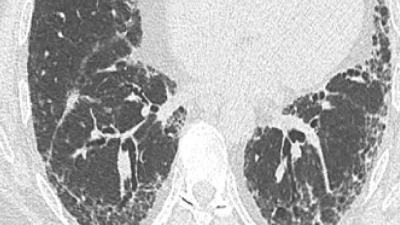 Granulomatous-Lymphocytic Interstitial Lung Disease (GLILD): A Case-Based Discussion - preview image