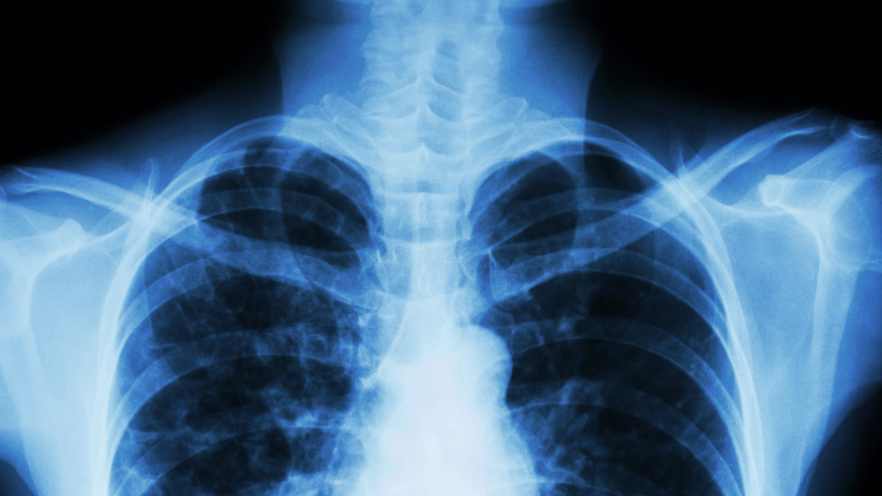 Colour of phlegm can predict outcomes for patients with bronchiectasis - article image