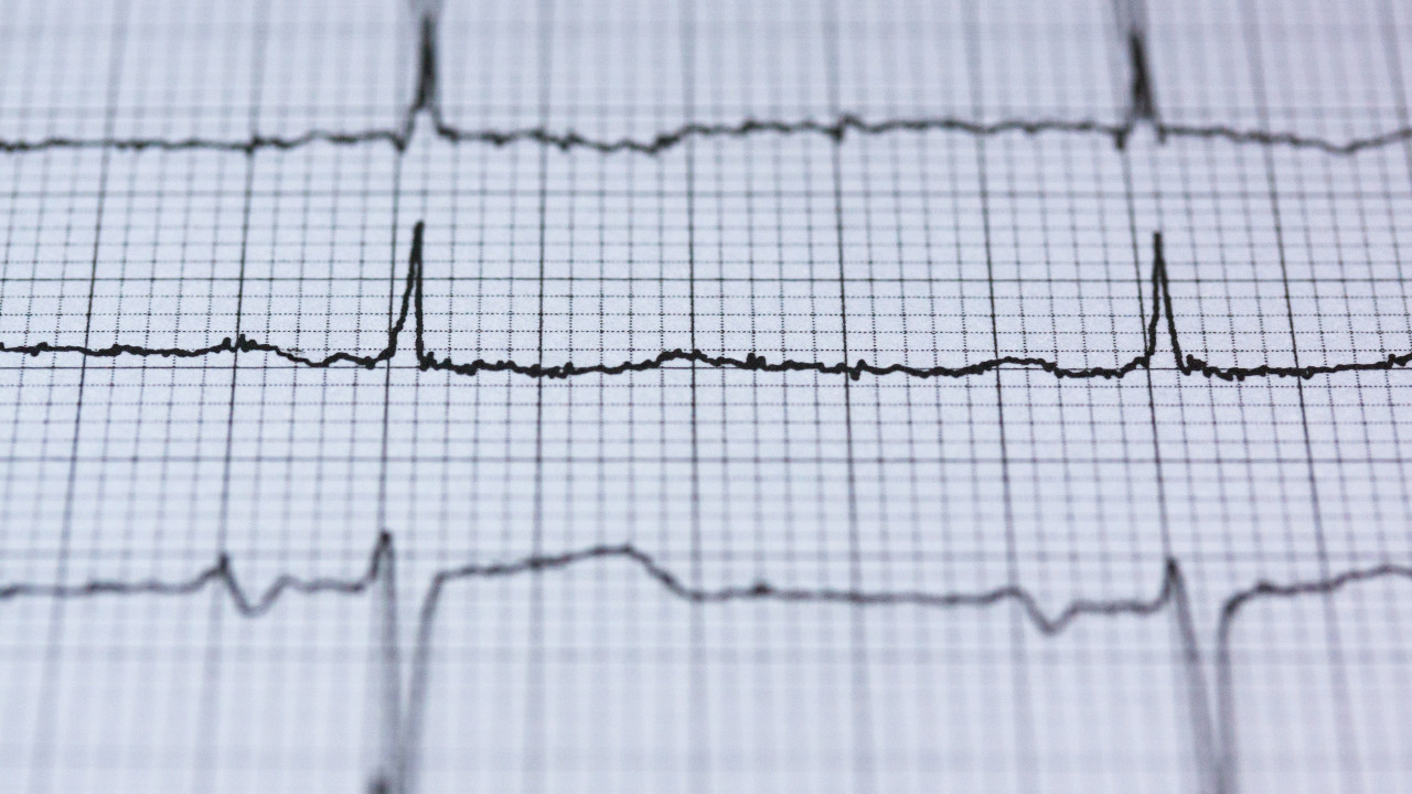 Pulse wave amplitude drops index: a biomarker of cardiovascular risk in obstructive sleep apnoea - article image