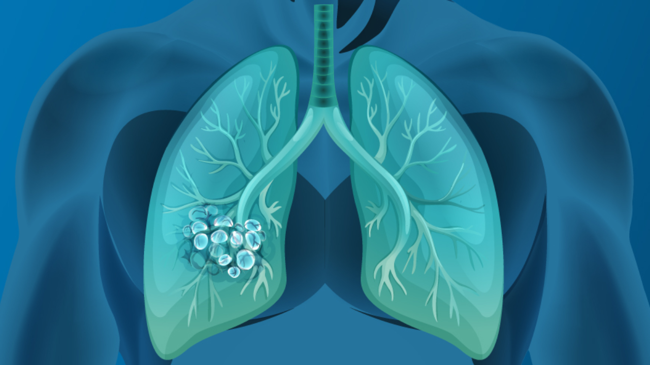 Panel discussion: Multidisciplinary Perspectives in Early Stage NSCLC - preview image