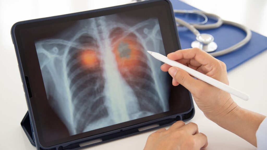Dissecting similarities and differences of exacerbations across different chronic airway diseases - preview image