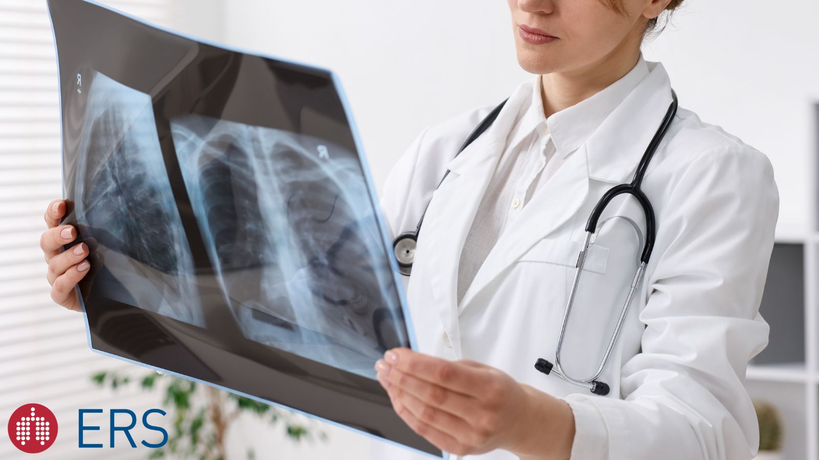 Journal Club – Pulmonary or extrapulmonary? Determinants of tuberculosis disease - preview image